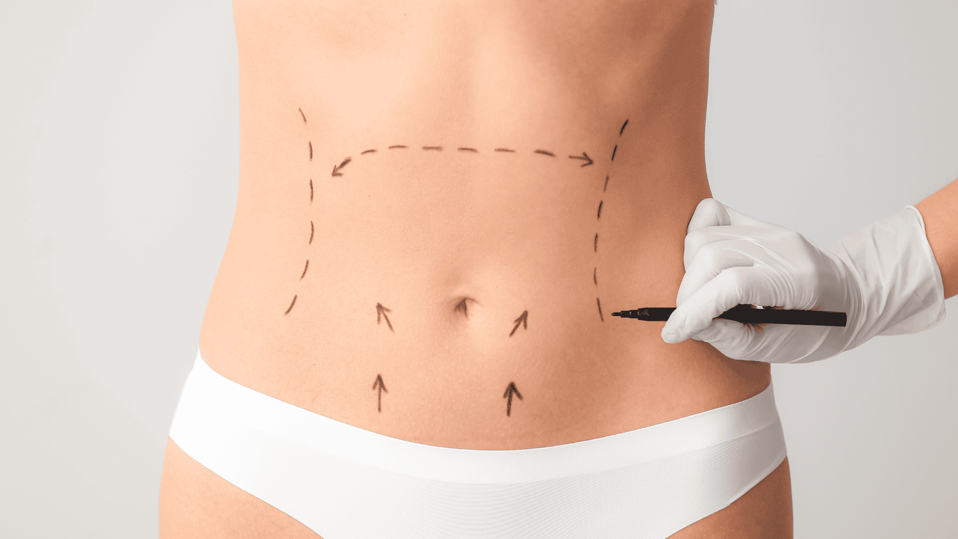 Abdominoplastia: Tudo o que precisa saber sobre esta cirurgia estética popular