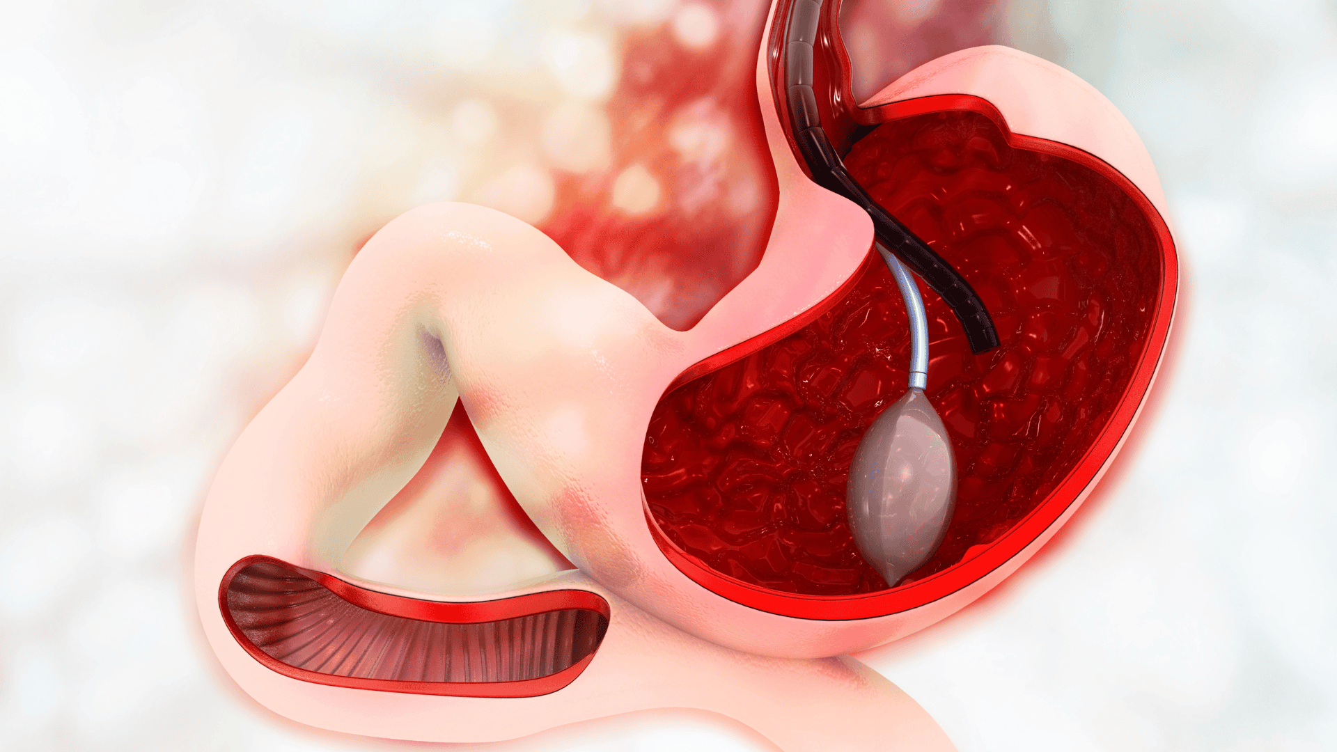 Ballon Gastrique, tout ce que vous devez savoir, les avantages, les risques et le processus