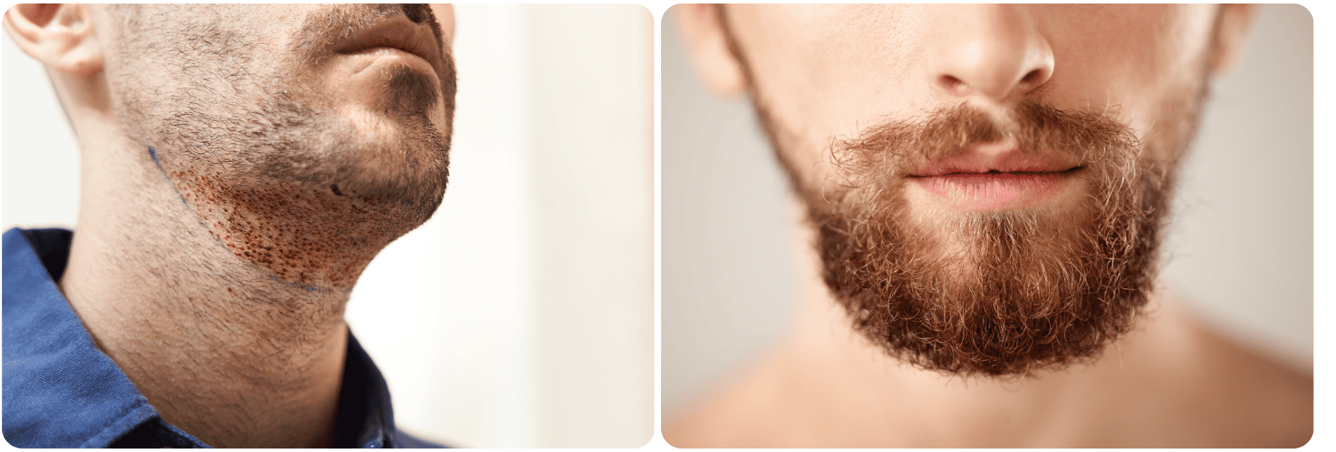Beard transplant in Turkey.png