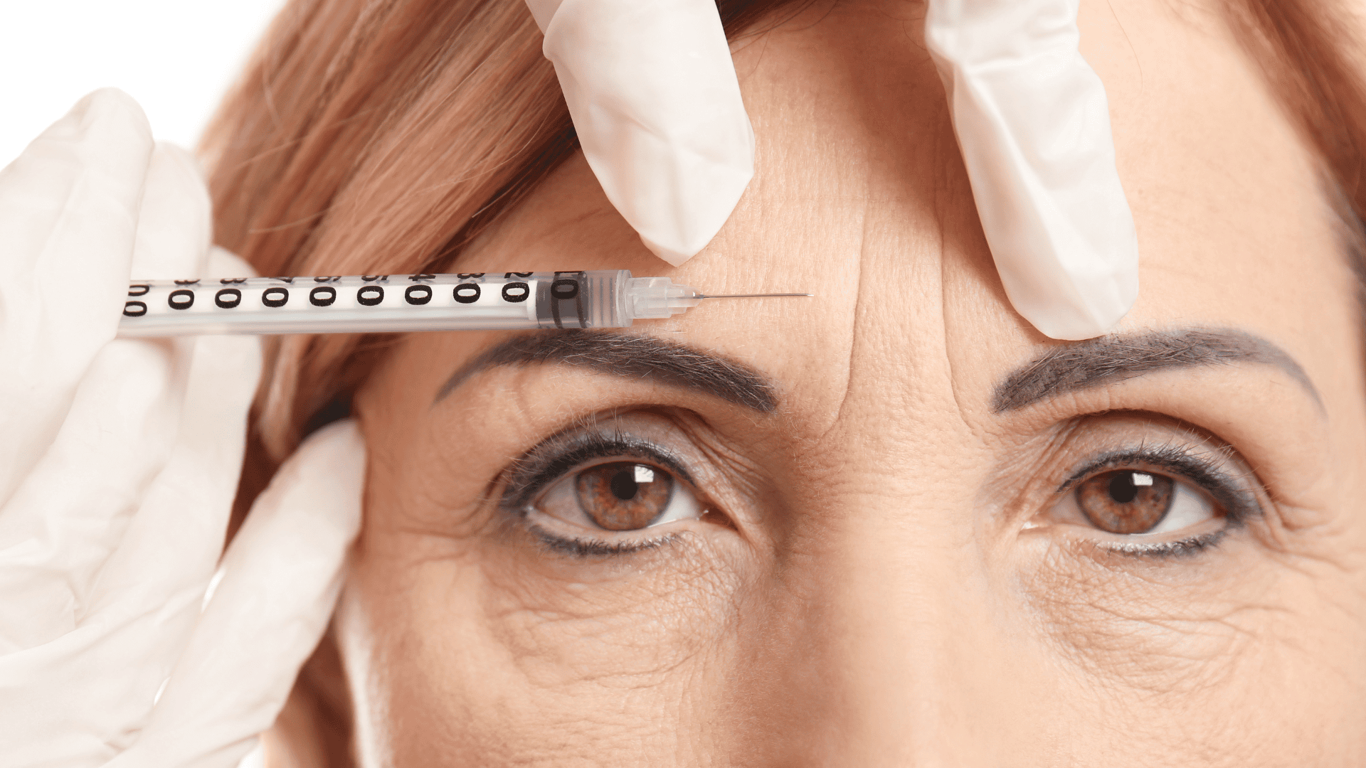 Botox: Tudo o que precisa saber sobre este tratamento estético popular