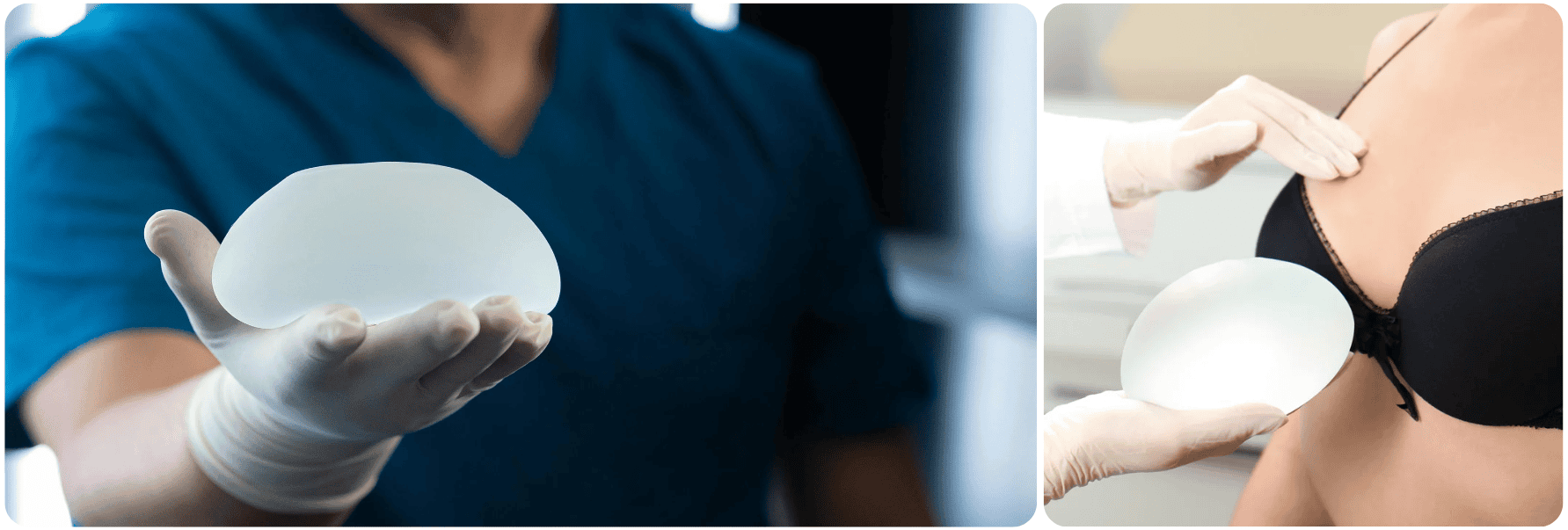 Capsular Contracture Correction11.png