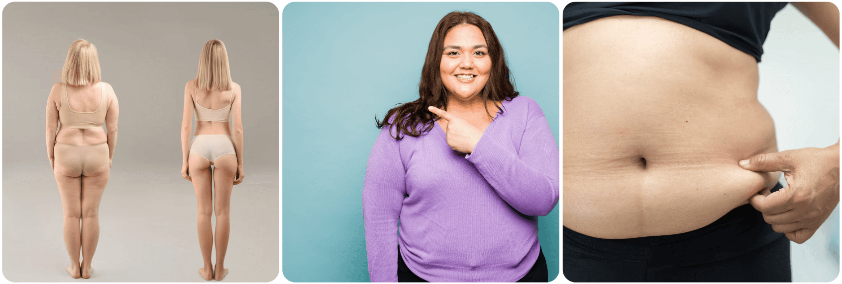 CoolSculpting (Cryolipolyse)2.png