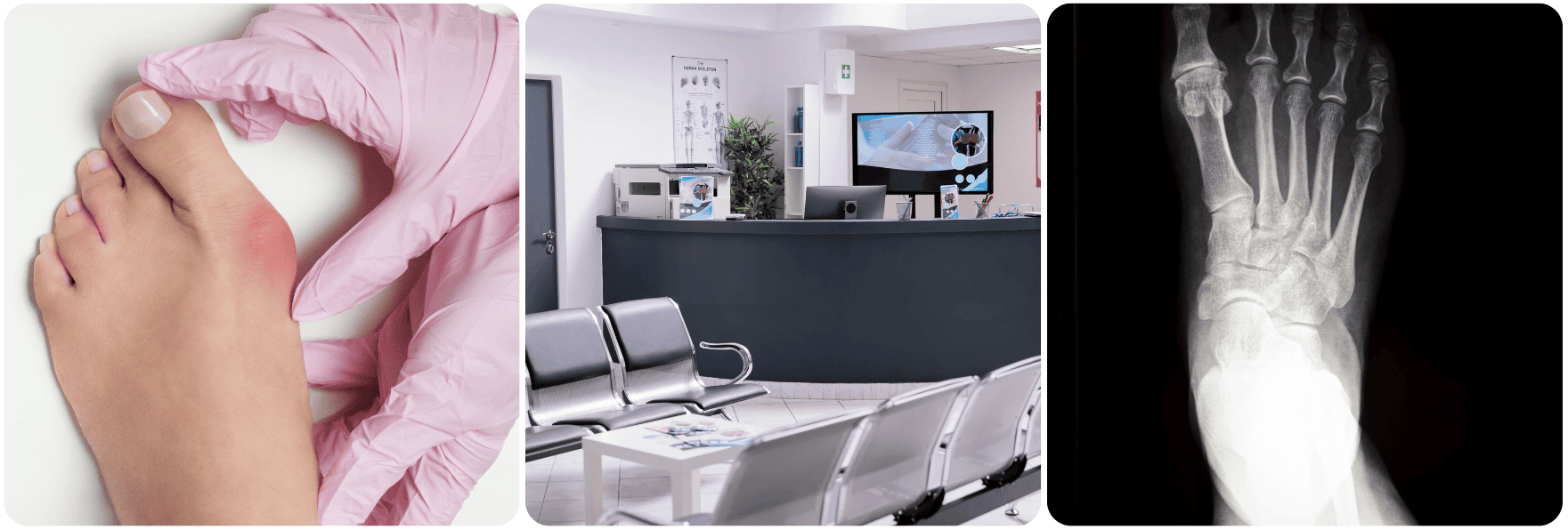 Corrección del Hallux Rigidus feet voet.png