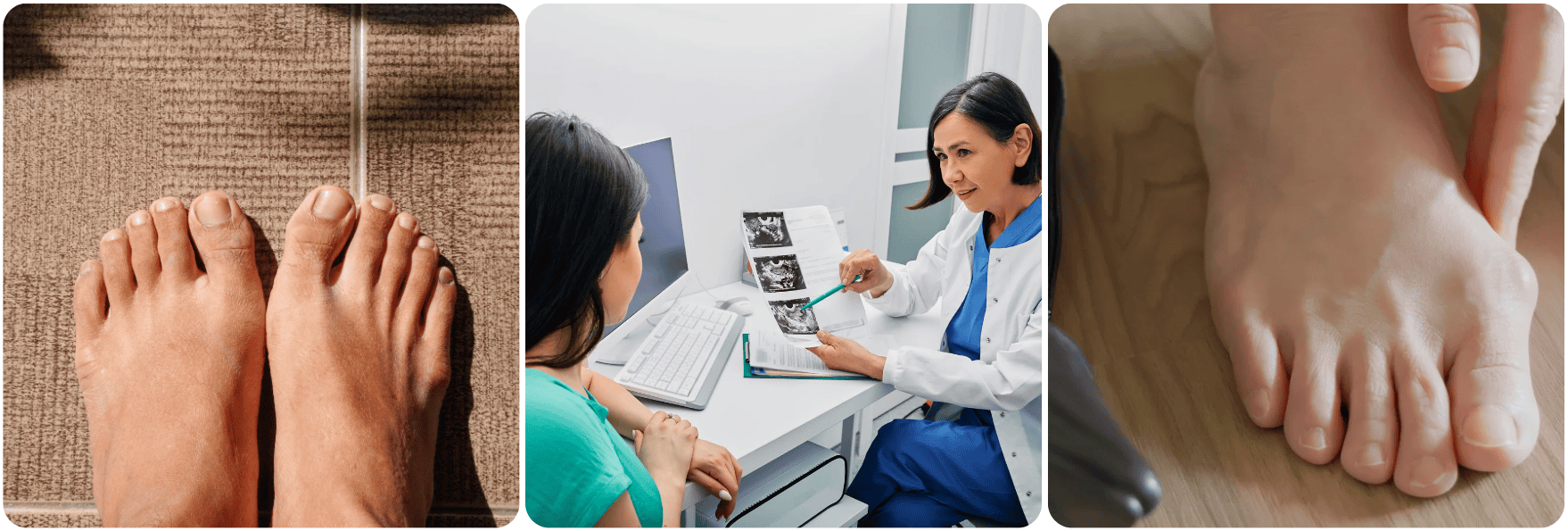 Corrección del Hallux Rigidus voet feet.png