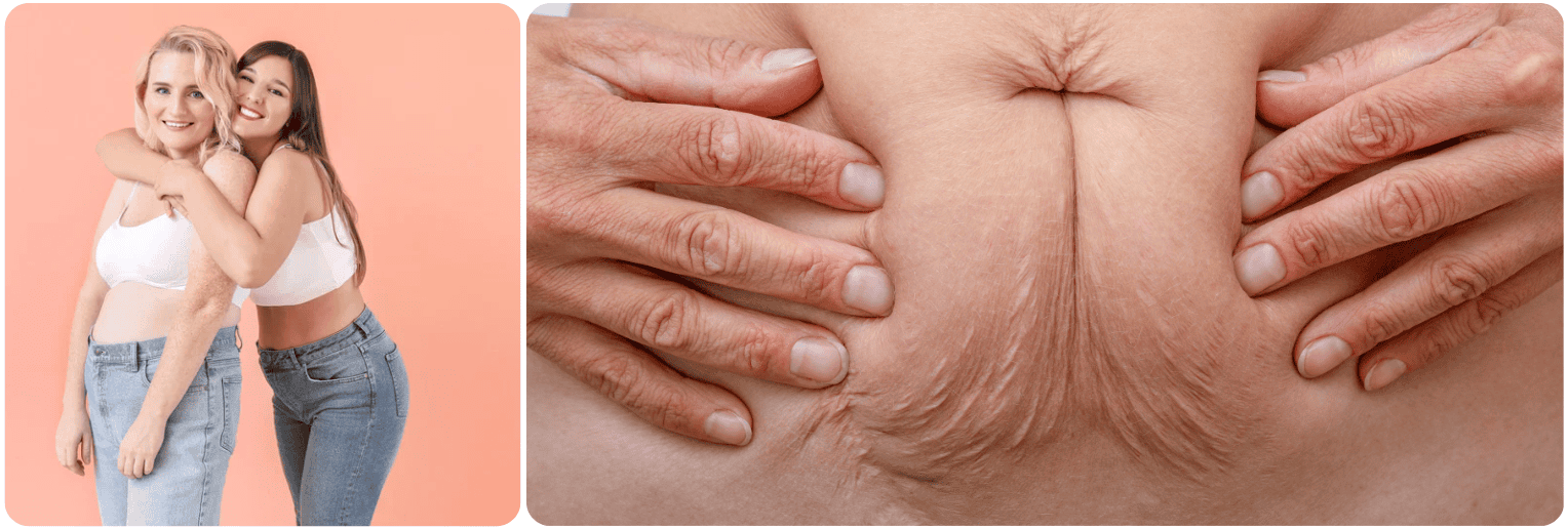 Fractional CO2 Laser.png