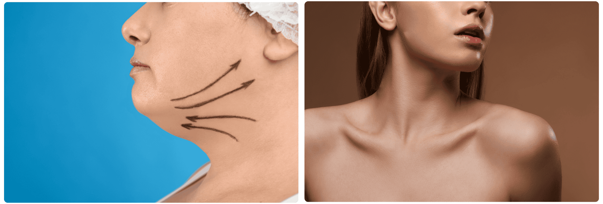 Gıdı liposuction.png