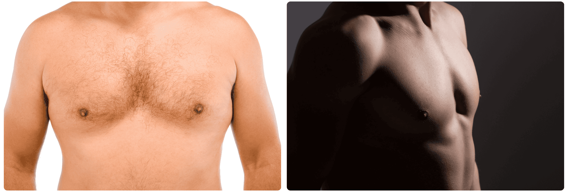 Gynecomastia.png