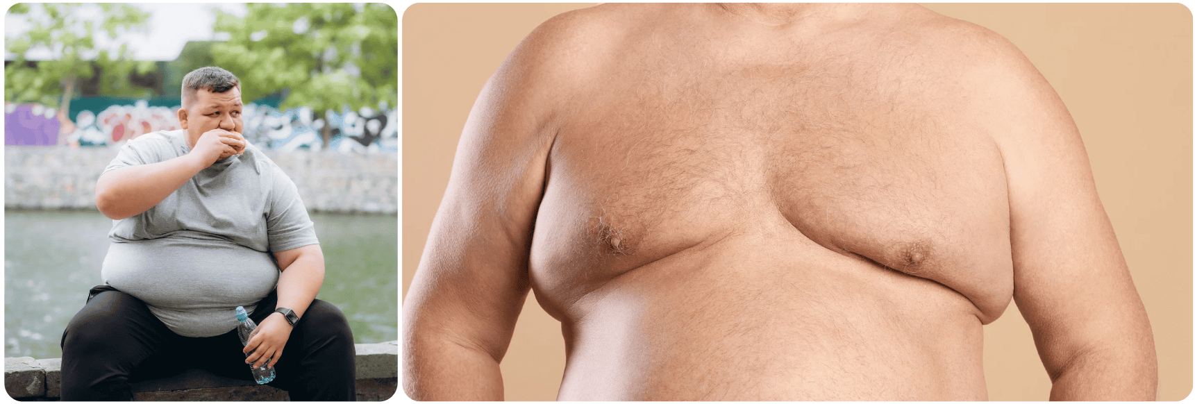 Gynecomastia surgery1.png
