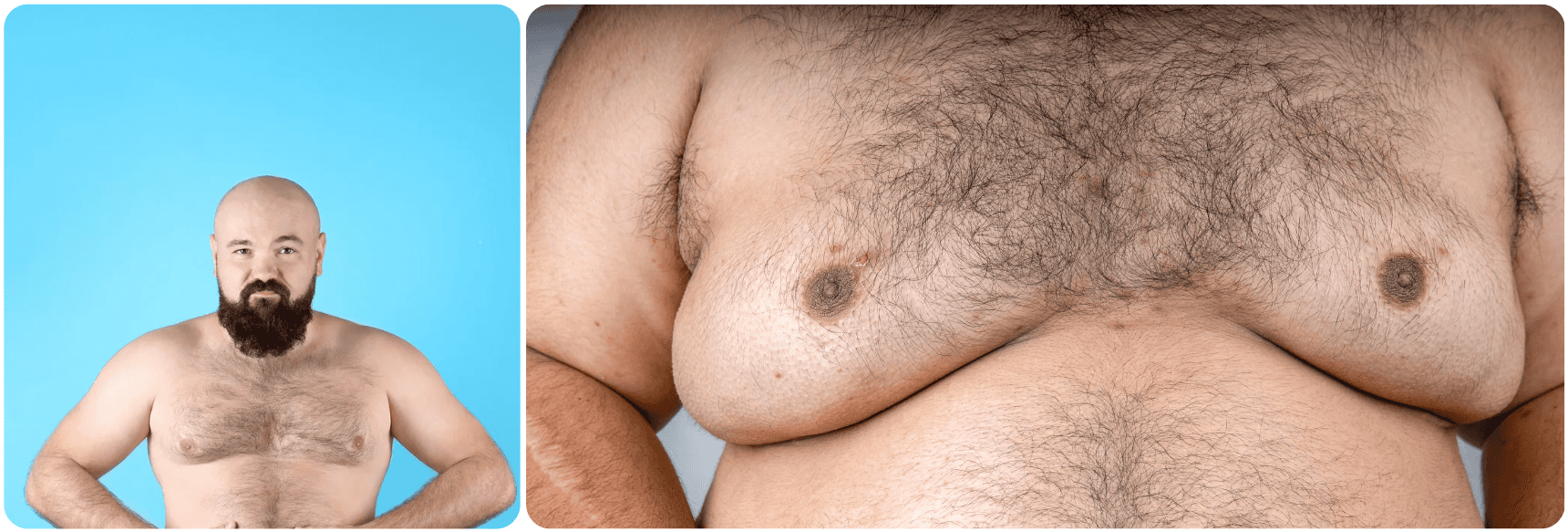 Gynecomastia surgery.png