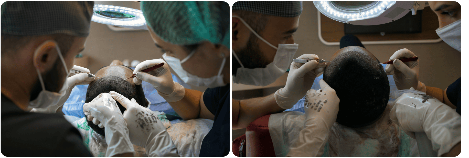 Hair transplant in Turkey.png
