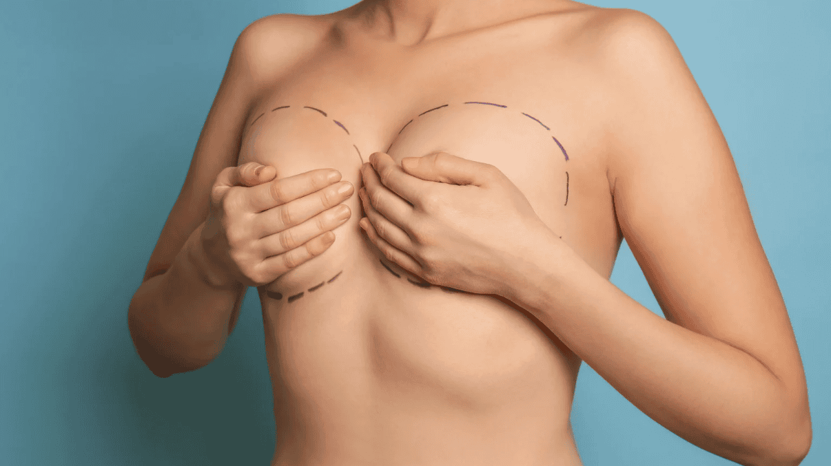 Lifting del Seno Periareolare