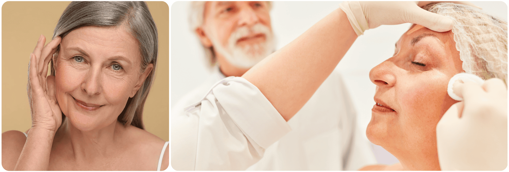 Lifting du Milieu du Visage mid facelift.png