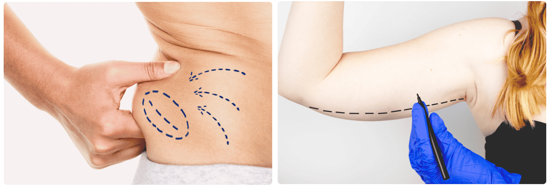 Liposuction.png