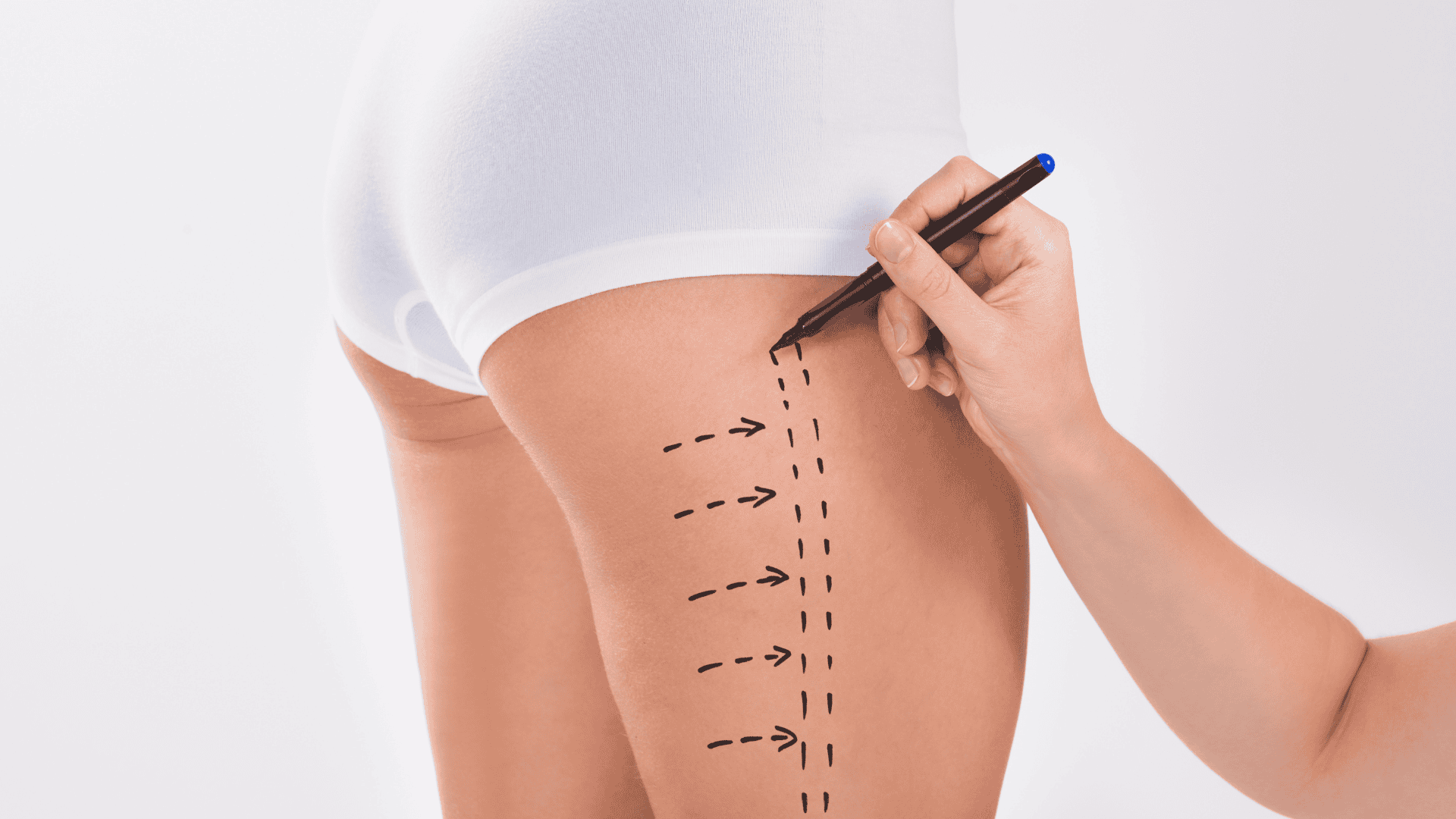 Liposuction (Bacaklar)