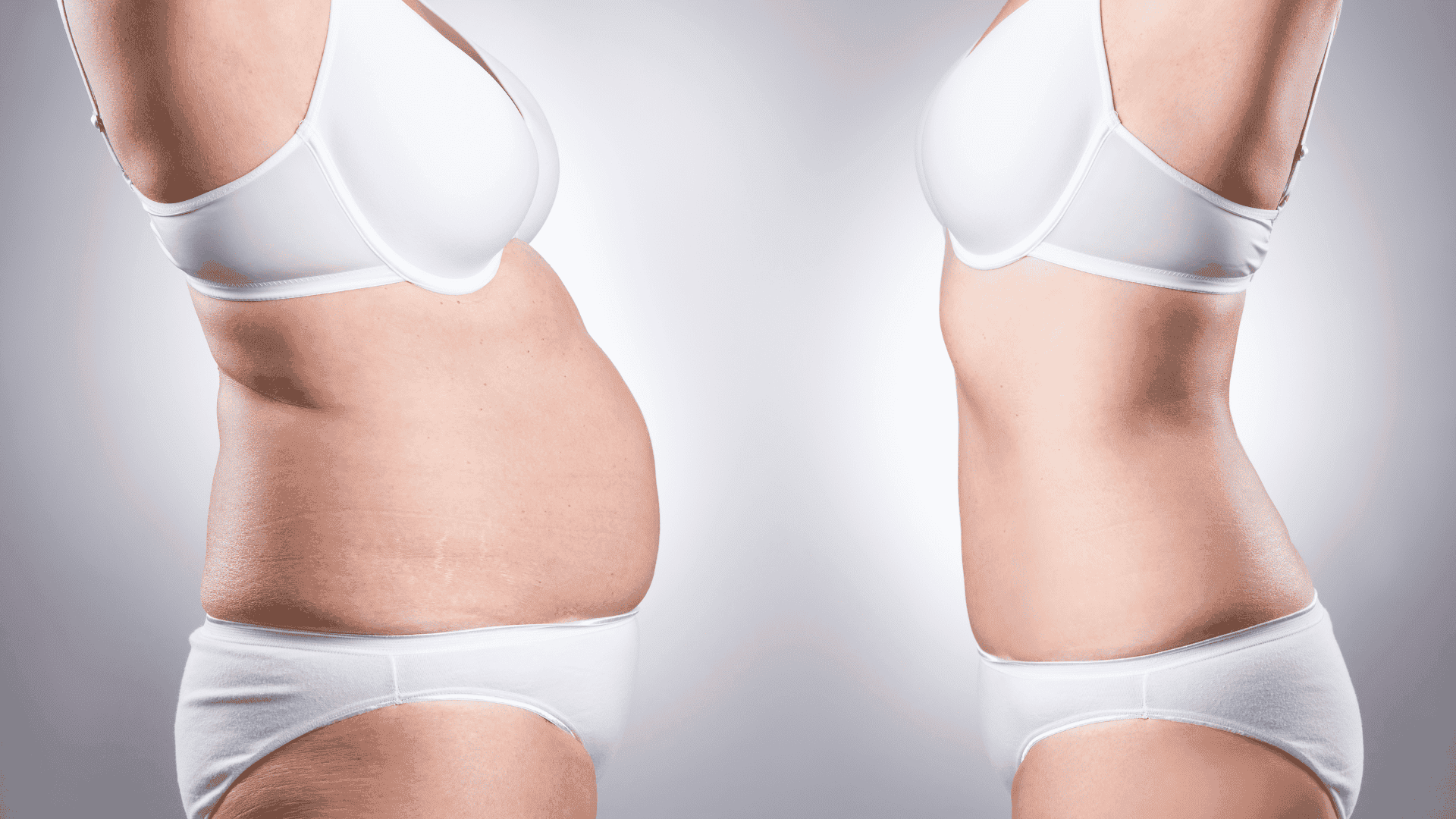 Liposuzione (Corpo)