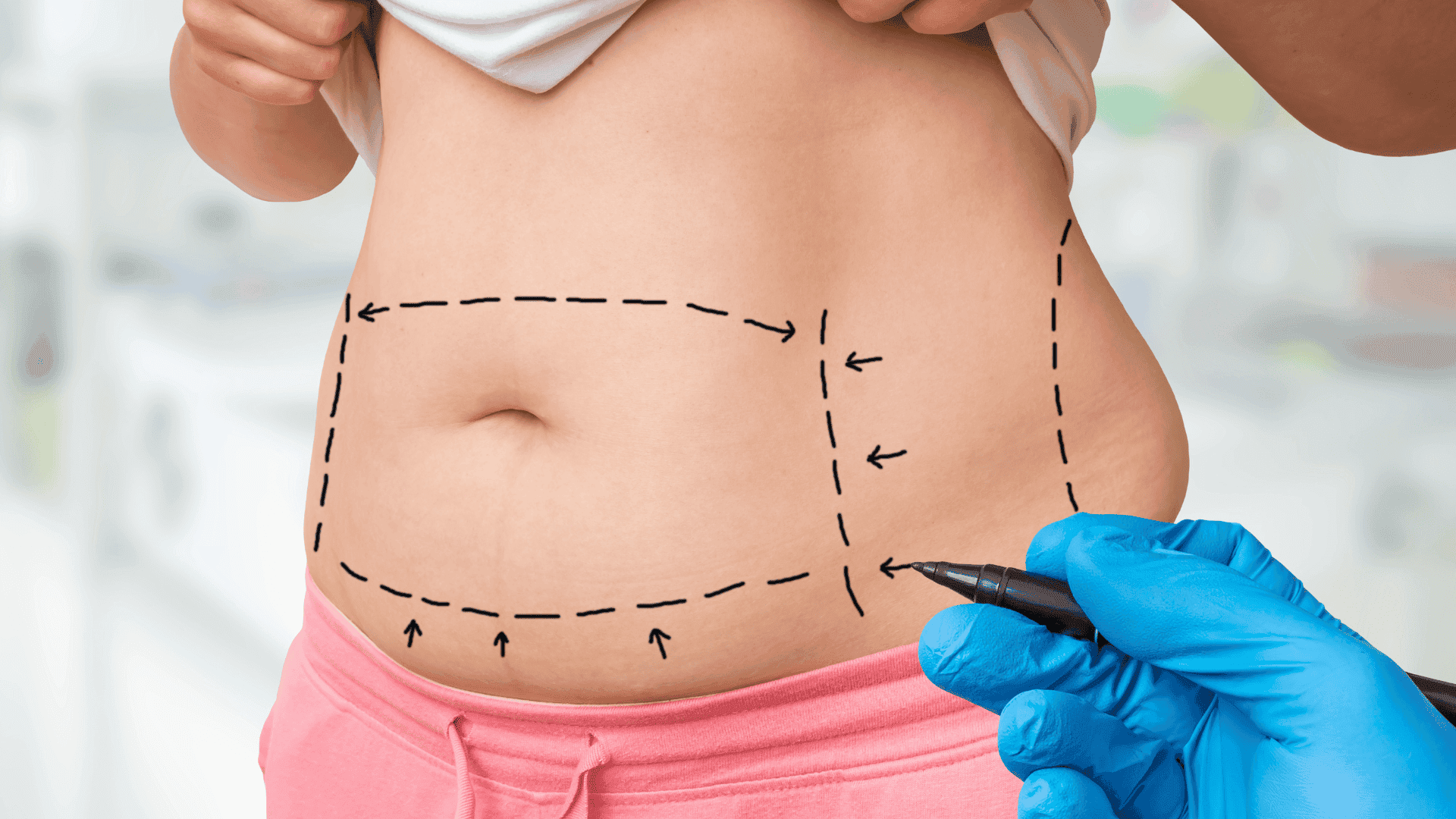 Abdominal Etching (Belly) explained in detail