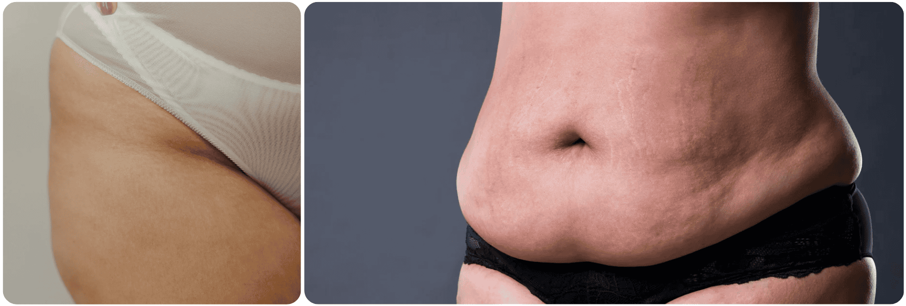 Microneedling for Stretch Marks1.png