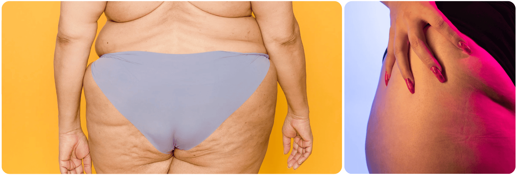 Microneedling for Stretch Marks.png