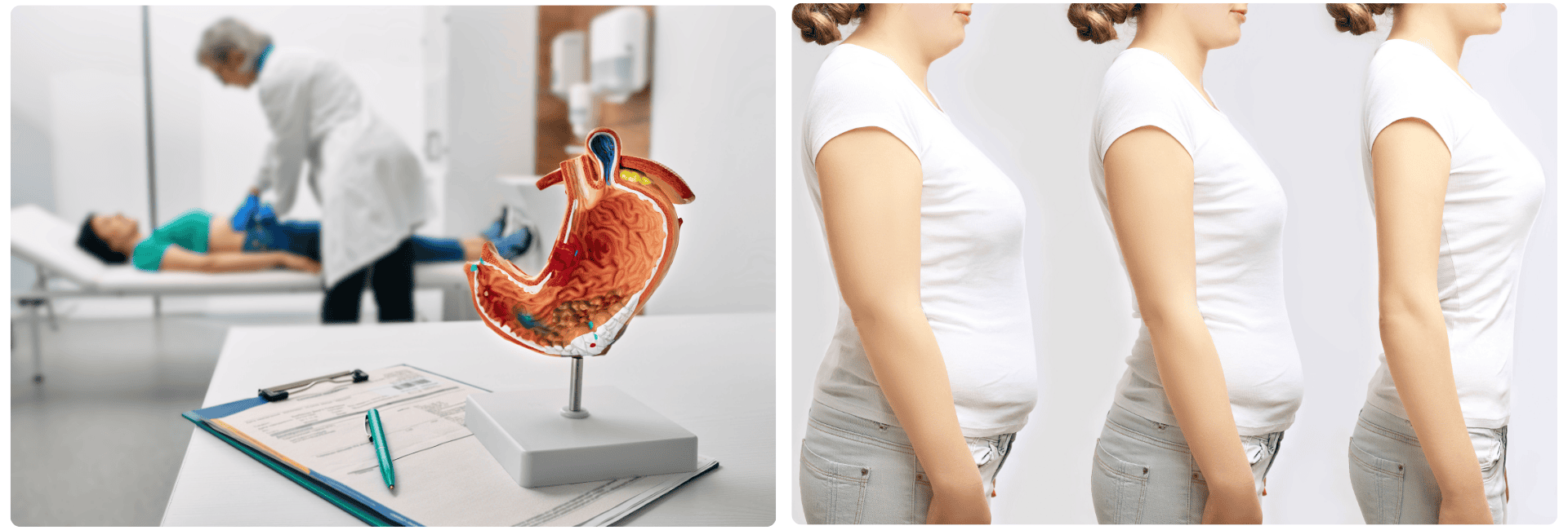 Mini gastrik bypass.png