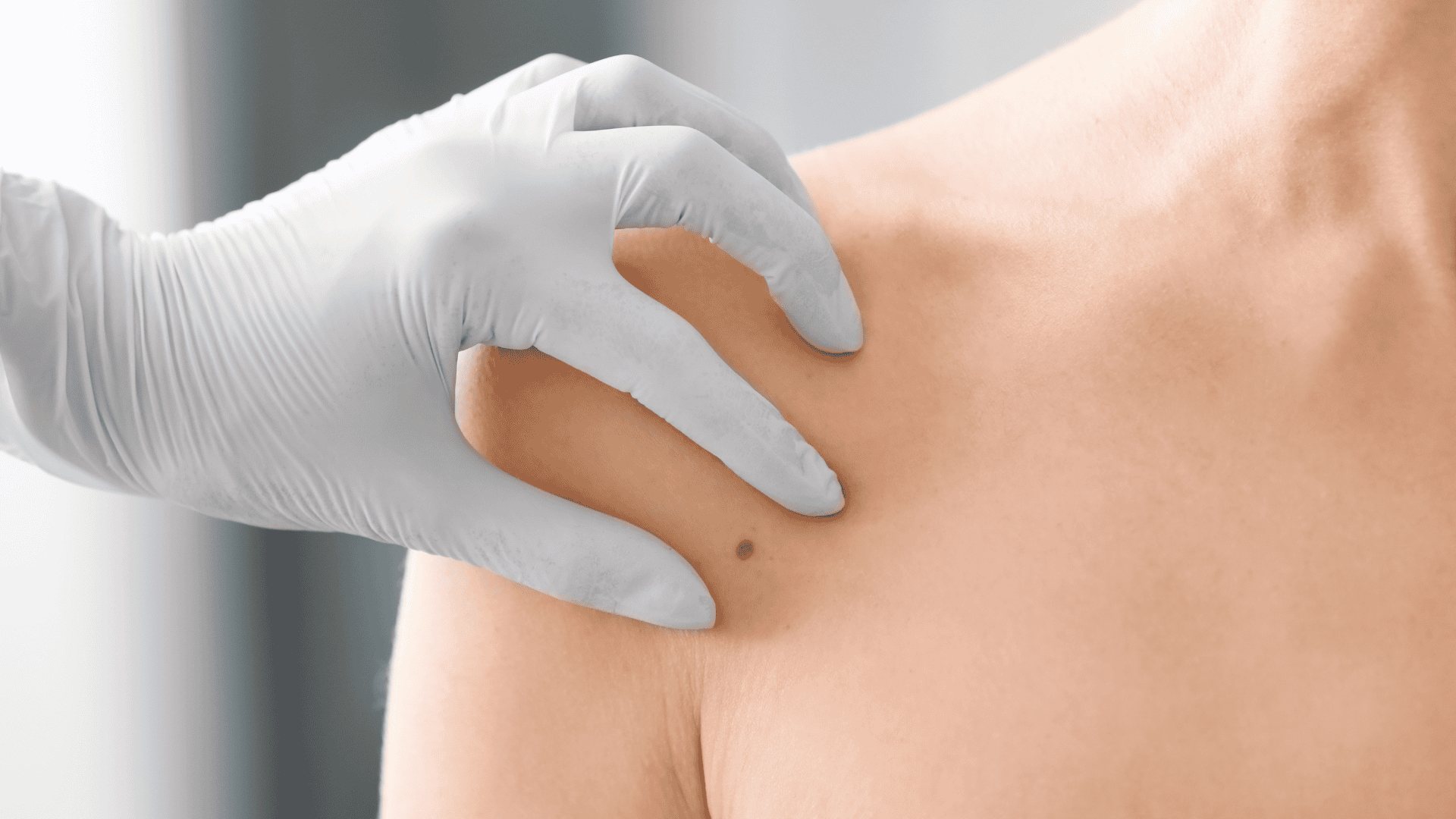 Muttermalentfernung? Vorteile, Risiken und Ablauf