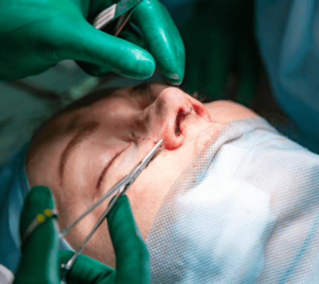 Rhinoplasty