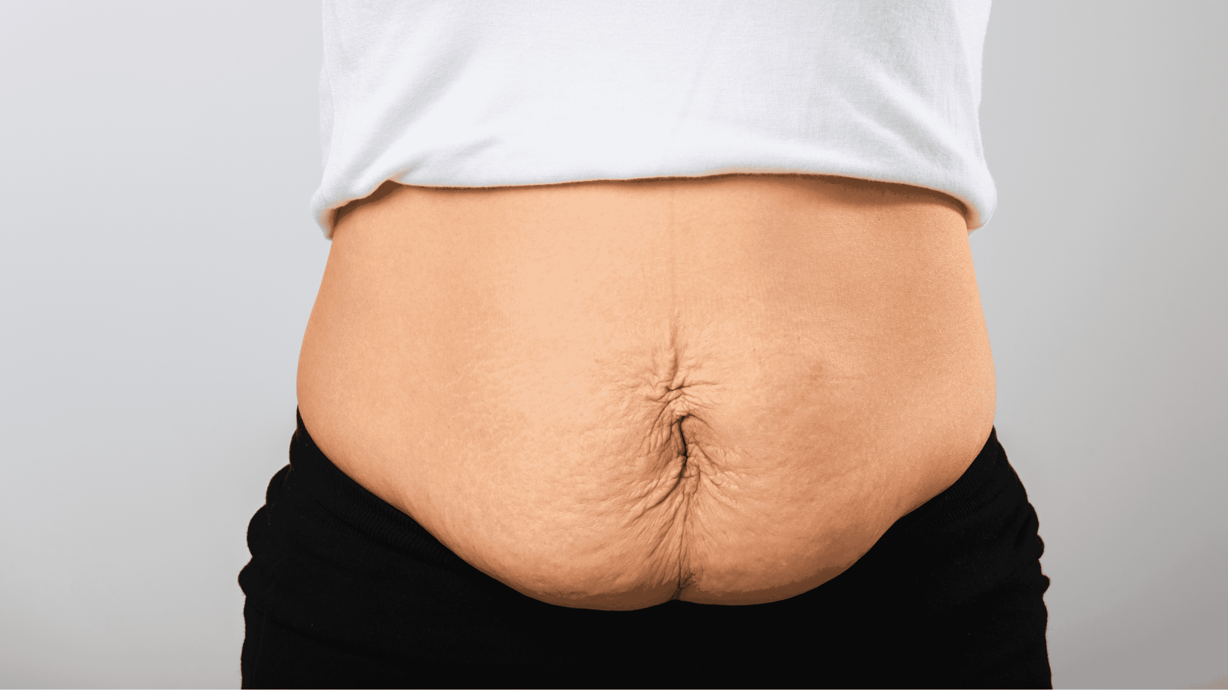 Surgery after weight loss, options and considerations