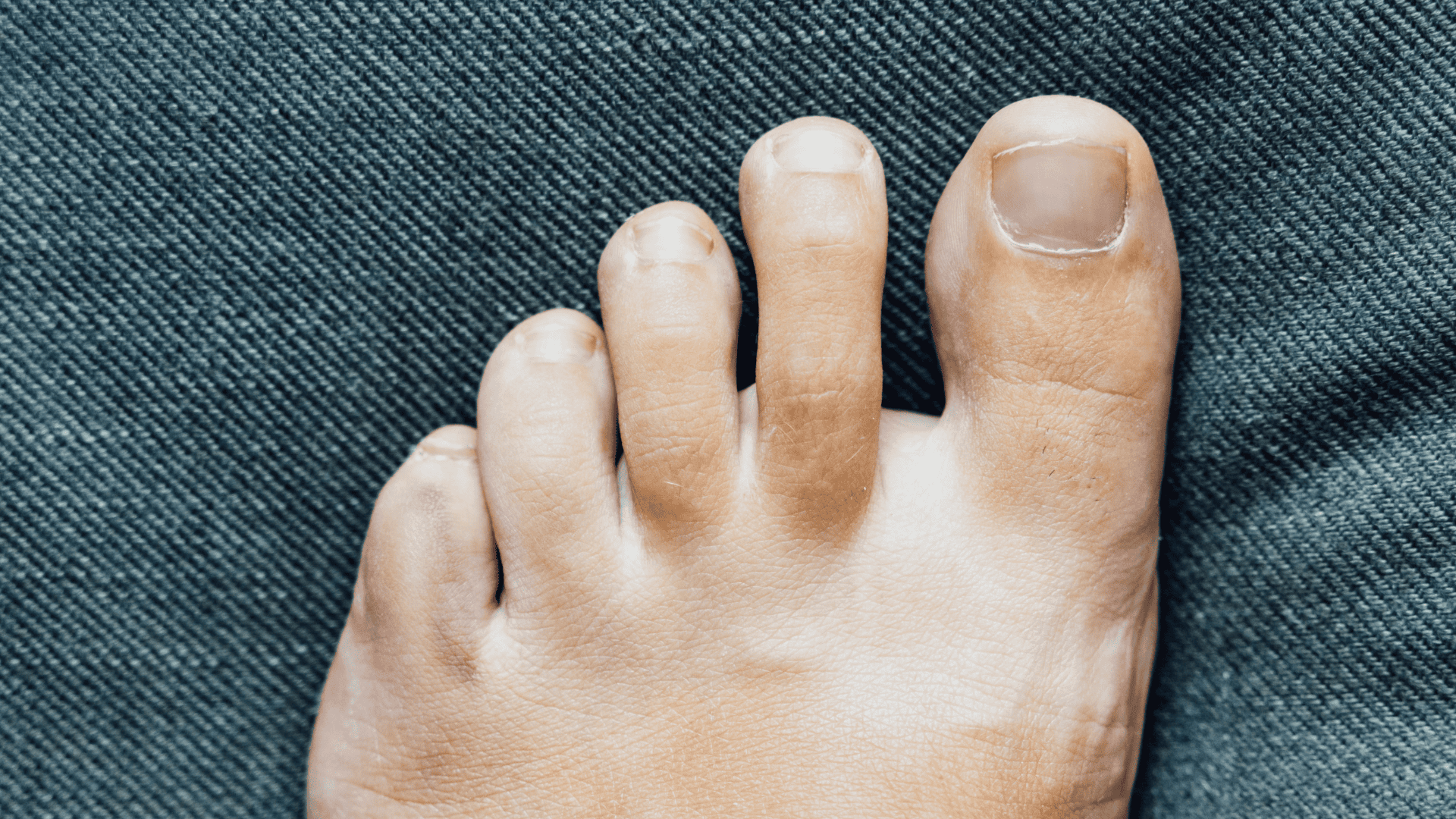 Toe Lengthening explained in detail