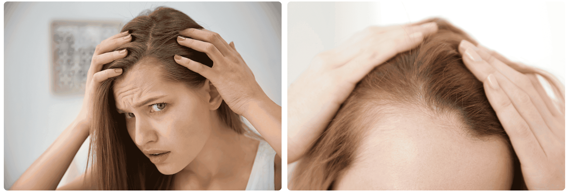 Trasplante de cabello para mujeres.png