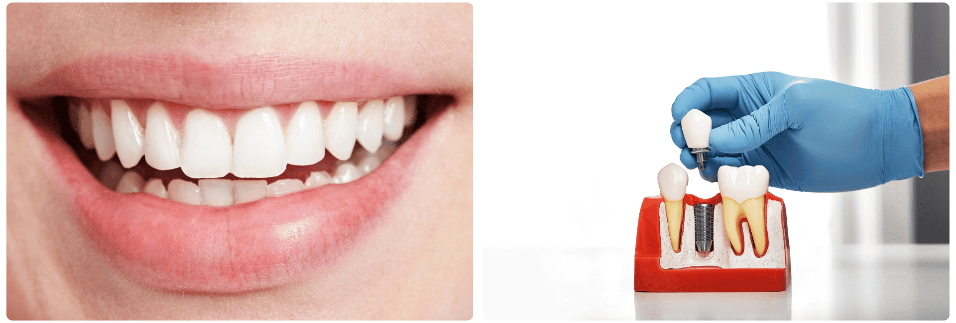 Türkiye'de dental implantlar.png