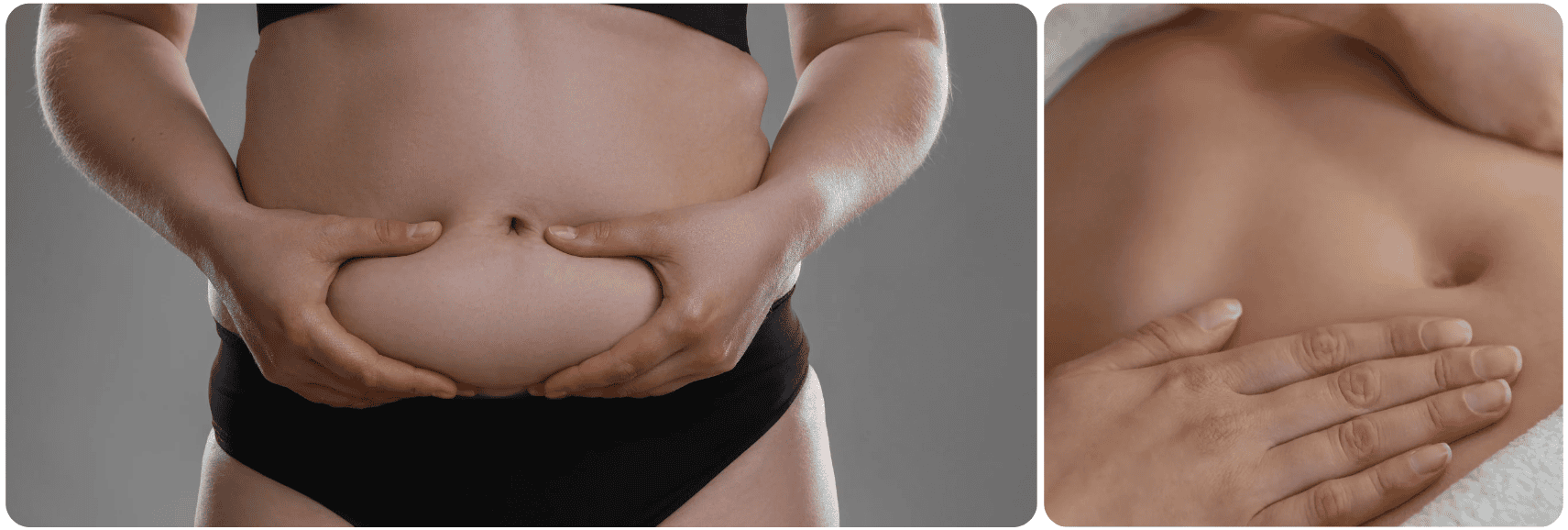 Tumescent Liposuction .png