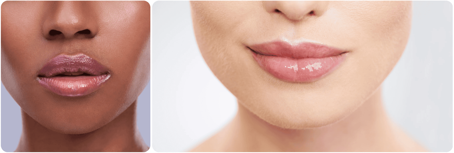 V-lijn Lip Correctie1.png