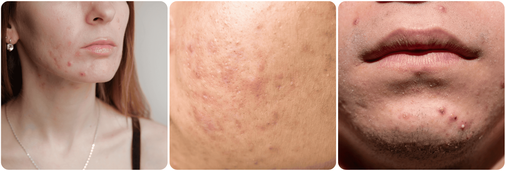 acne gezicht tedavi.png