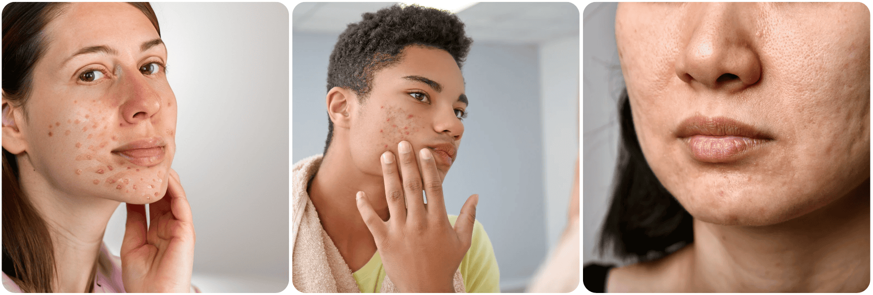 acne scar.png