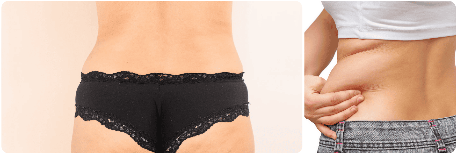 back rug sirt lazer lipo.png