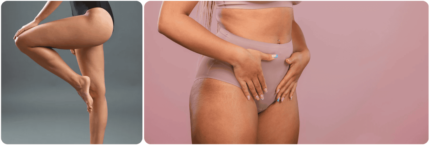 benen legs dijbenen lipo.png