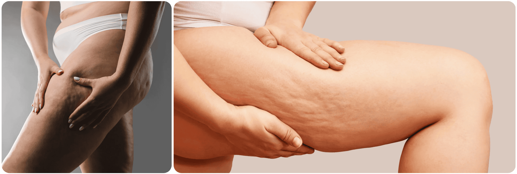 cellulite benen .png