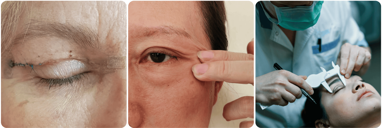 eyelid blefaroplasti.png
