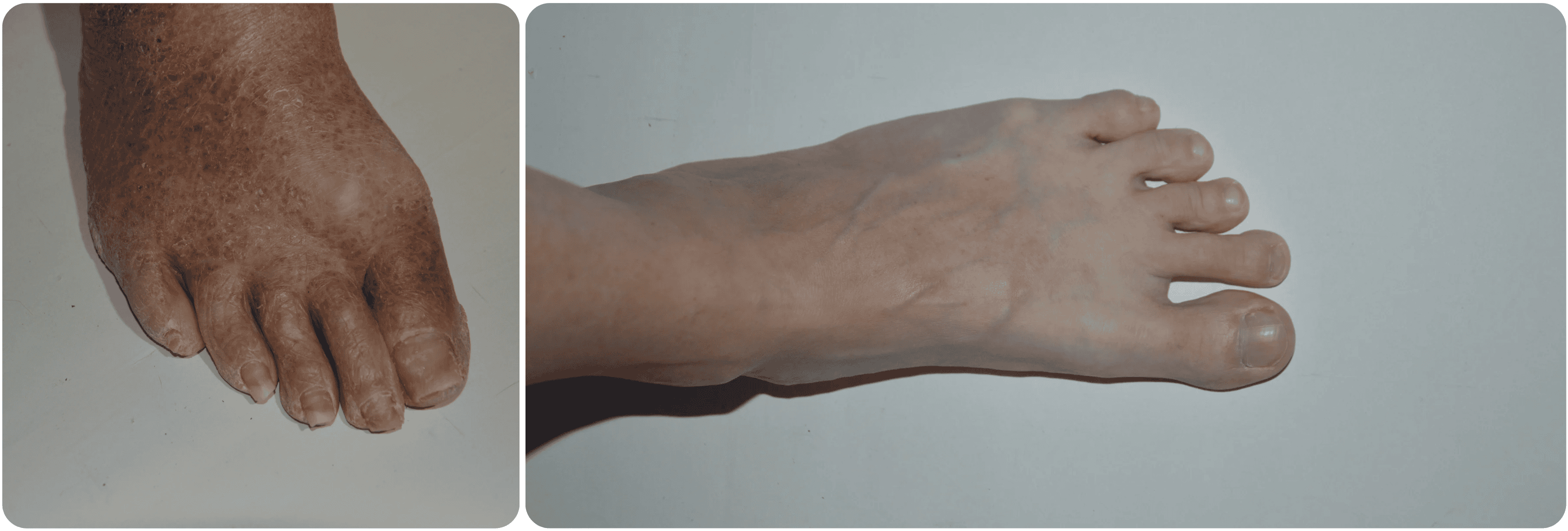 feets voeten operatie tenen.png