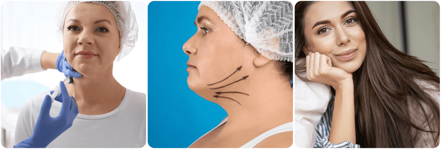 kin chin implant.png