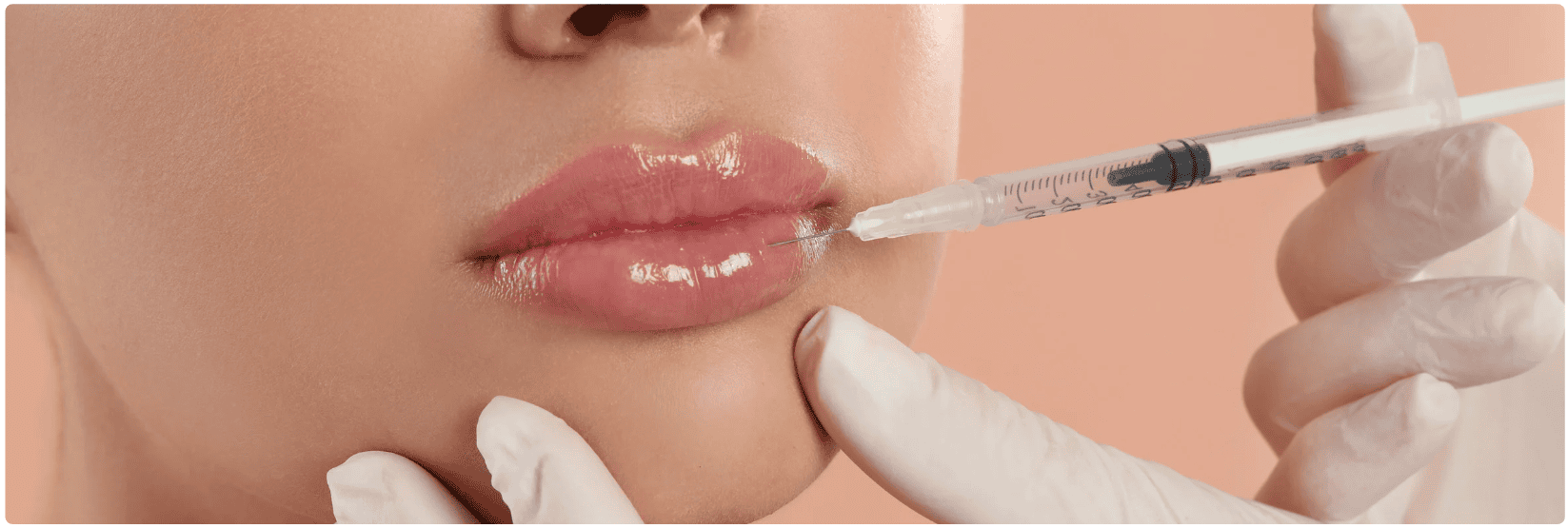 lippen fillers.png