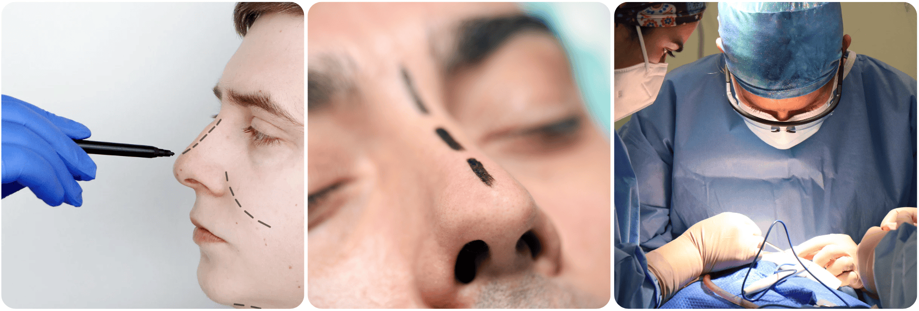 men nose surgery.png