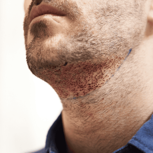Trapianto di Barba