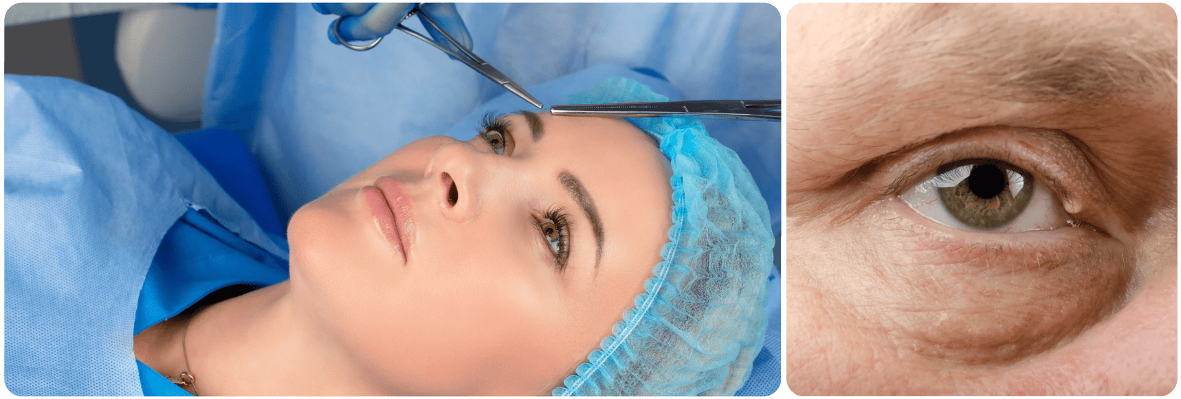 ooglid goz kapagi.png