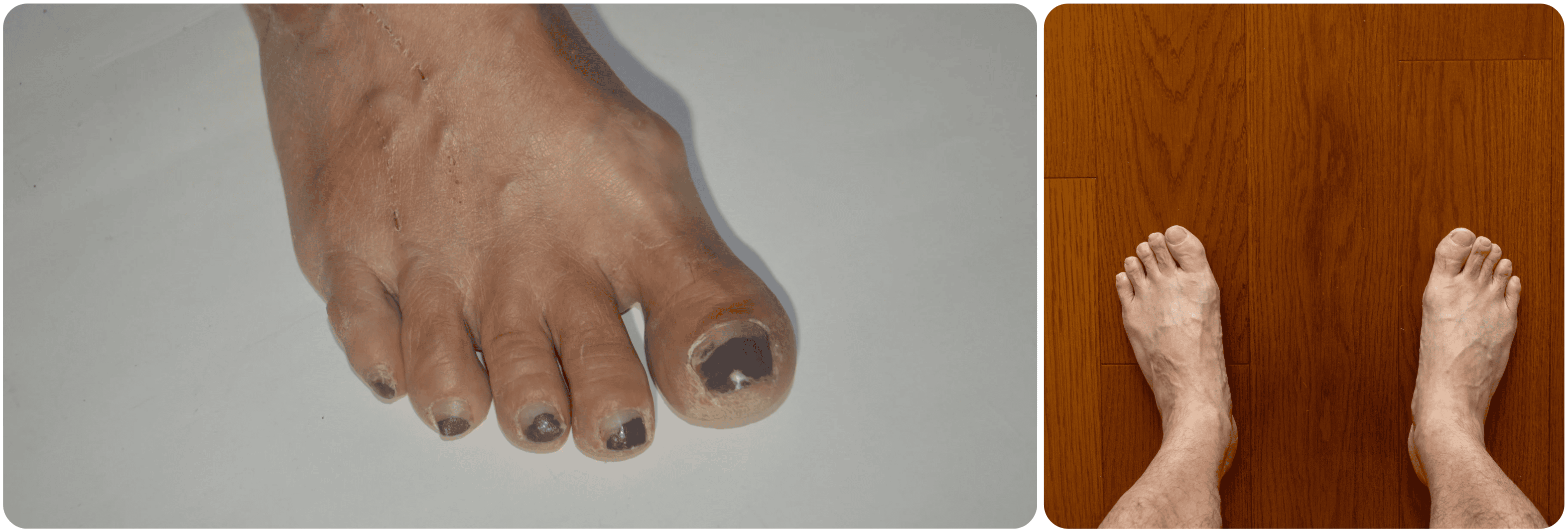 operatie voeten feet tenen.png