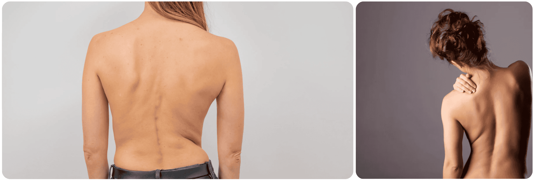 rug back sirt lazer liposuction.png