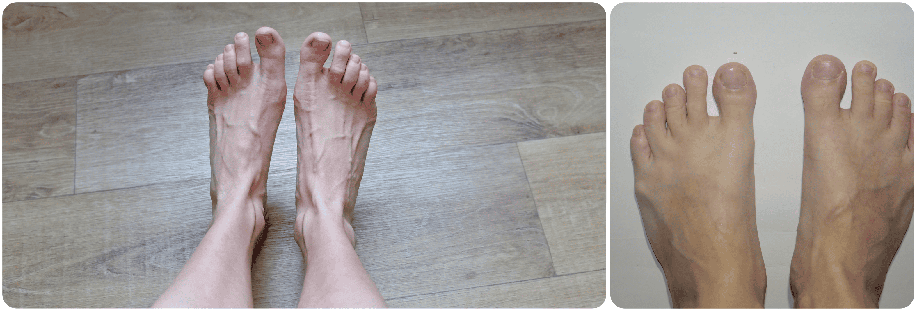 tenen voeten surgery feets.png