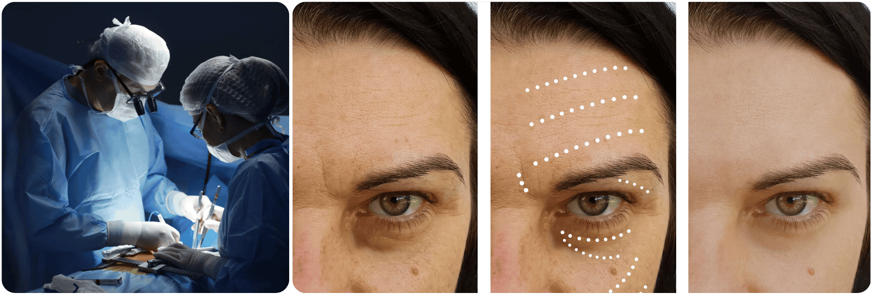 voorhoofd fore head Lifting de Frente .png